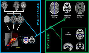 Check for platform availability and play today! Voxel Based Analysis Of Gray Matter Relaxation Rates Shows Different Correlation Patterns For Cognitive Impairment And Physical Disability In Relapsing Remitting Multiple Sclerosis Sciencedirect