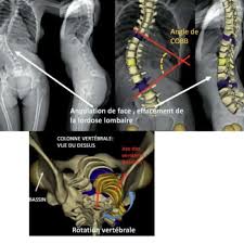 Pourquoi un matelas pour scoliose ? Scoliose De L Adulte Que Faire Espace Francilien Du Rachis
