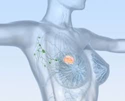 Eine entfernung der lymphknoten im halsbereich wird neck dissection genannt. Operation Bei Brustkrebs