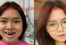 Phẫu thuật hàm hô