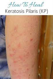How I Healed My Keratosis Pilaris Kp Naturally Part One Keratosis Pilaris Skin Healing Skin Bumps