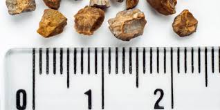 They form as a result of an excess of minerals or other deposits in the kidneys, and they can become lodged in the ureters, the bladder or the urethra. Can You Pass An 8mm Kidney Stone Pristyn Care