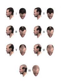 30 giovani uomini su 100 soffrono di perdita di capelli precoce e questo è dovuto a cause genetiche ed ereditarie. Diradamento Capelli Chirurgia Estetica Capelli Pallaoro Medical Laser