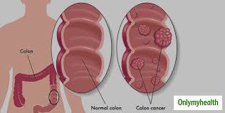 In this article signs and symptoms of colon cancer different methods of colon cancer screening World Cancer Day 2021 Young Men Should Not Ignore These Symptoms Of Colon Cancer