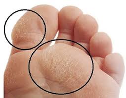 They are caused by excessive pressure or rubbing (friction) on the skin and can lead to foot problems, especially on walking. Foot Corns Calluses Causes Treatment Foot Pain Explored