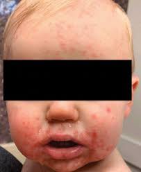 This rash will often remain for weeks at a time. Blistering Rash In A 1 Year Old Boy