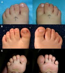 Image result for Syndactyly