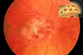 Image result for HIV Retinitis