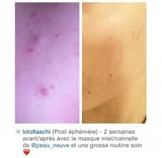 En utilisant un peeling au citron maison, on obtient un renouvellement cellulaire après quelques séances. Masque Anti Points Noirs Ou Pores Dilates Peau Neuve