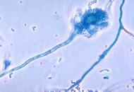 Image result for ALS parasites fungus molds