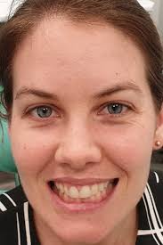 Clear Aligners Special