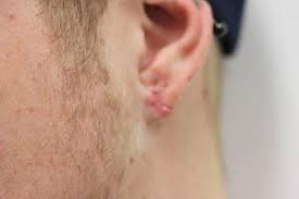 Navigating the choices for skin cancer treatment starts with understanding your options. Ear Lobe Surgery Mona Vale