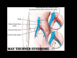 Dvt Causes Treatment May Thurner Syndrome Causing Dvt Chronic Venous Hypertension In Hyderabad Youtube