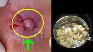 9 Proven Natural Home Remedies For Hemorrhoids During Pregnancy Youtube