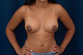 Tubular (Tuberous) breast shape - How to correct with implants | Ricardo L.  Rodriguez MD, Baltimore Plastic Surgeon