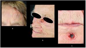 Cutaneous Squamous Cell Carcinoma: From Pathophysiology to Novel  Therapeutic Approaches