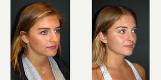 Andrew Jacono, MD, Board Certified Facial Plastic Surgeon