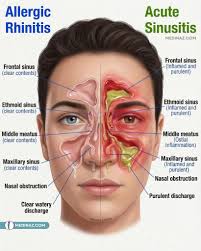 Image result for Rhinitis
