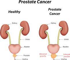 He was diagnosed 11 months ago and at that point it was stage 2 with a gleason score of 8. Prostate Cancer Diagnosis Risk Currae Hospitals