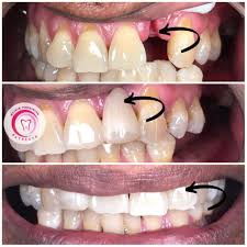 Temukan berbagai klinik gigi terbaik hanya di hdmall. Rawatan Frc Bridge Klinik Pergigian Batrisya Facebook
