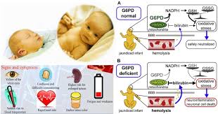 Image result for G6PD Deficiency Detection