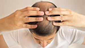 Maybe you would like to learn more about one of these? Generasi Millennial Rentan Alami Kerontokan Rambut