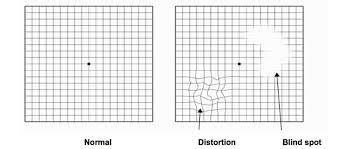 Retina Boston Macular Degeneration Boston Neec