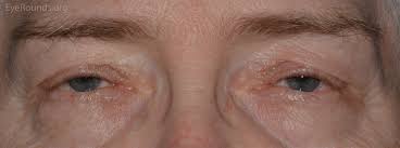 480 x 360 jpeg 14kb. A Primer On Ptosis