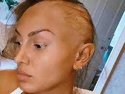 Ex On The Beach star ZaraLena Jackson undergoing alopecia treatment after  losing hair