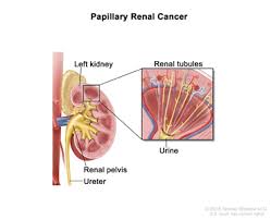 The kidneys play a large role in the most commonly, kidney cancer is detected incidentally on imaging for some other purpose and has no signs or symptoms. Hereditary Syndromes Associated With Kidney Cancer Renal Cell Cancer Pdq Genetics Patient Information Nci Michigan Medicine