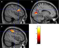 The meaning of the awareness ribbons are based on their color or color combination. Uottawa Study Shows That Mindfulness Can Help Ease The Pain Of Breast Cancer Survivors Eurekalert Science News
