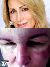 In 2009, Carol Bryan from Florida received facial fillers injected into the  wrong area, causing her forehead to swell so much she had to tape her eyes  open to see. A botched