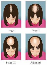 Before you start every distaff hair loss treatment, discuss the problem to a academic. Female Pattern Baldness Healthdirect