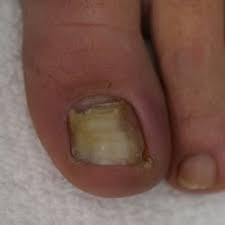 five things to know about foot fungus