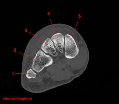 The muscles are located mainly in the sole of the foot and divided into a central (medial) group and a group on either side (lateral). Anatomy Of The Ankle And Foot W Radiology