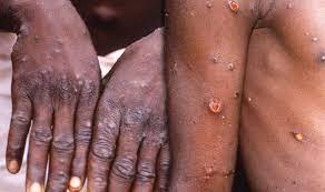 Check spelling or type a new query. What Is Monkeypox Watch Out For These Signs And Symptoms Of The Infectious Disease Express Co Uk