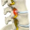 How long does it take to recover from cervical radiculopathy? 1