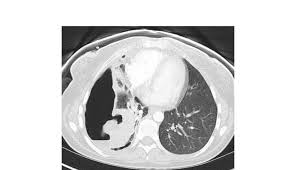 Image result for Rhodococcus equi