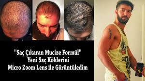 Sac Cikaran Mucize Kur Ve Sonuclari Youtube
