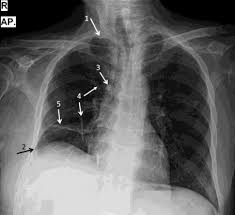 We did not find results for: Https Www Researchgate Net Profile Laura Ciobanu Publication 335950396 Semiologie Si Patologie Radiologica Toracica Pentru Studentii Anului Iii Medicina Generala Links 5d85357f458515cbd1a3f1ab Semiologie Si Patologie Radiologica Toracica Pentru Studentii Anului Iii Medicina Generala Pdf
