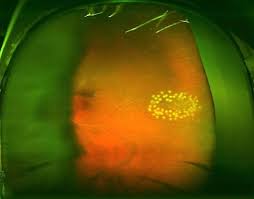 This allows fluid from within your eye to slip through the opening and get behind your retina. Floaters Retinal Tears And Retinal Detachments Visionaware