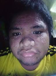 No one should face psoriasis alone. 💙 Having a strong support  system—family, friends, or a community—can make a huge difference. Tag  someone who has been a great support system for you! #StrongerTogether #