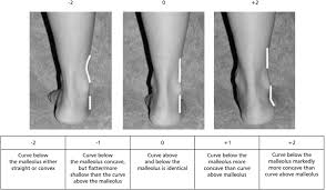 Malleolus coronal section through right talocrural and talocalcaneal joints. The Curves Above And Below The Lateran Ankle Malleoli Download Scientific Diagram