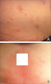 Autoimmune Progesterone Dermatitis Mdedge Dermatology