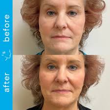 Meet Katie Winner, RN