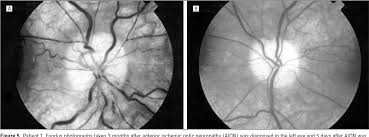 Posterior synechia).synechiae can be caused by ocular trauma, iritis or iridocyclitis and may lead to certain types of glaucoma. Pdf Anterior Ischemic Optic Neuropathy In Eyes With Optic Disc Drusen Semantic Scholar
