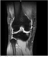 (minor sprain) high signal is seen medial (superficial) to the ligament, which looks normal grade 2: Figure 1 From Medial Collateral Ligament Injury A New Classification Based On Mri And Clinical Findings A Guide For Patient Selection And Early Surgical Intervention Semantic Scholar