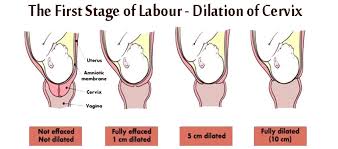 If it's your first labor, it may last longer than those who have had previous births once you're in labor, your healthcare provider will check your cervix regularly to keep track of how effaced and dilated you are as you get closer to. The First Stage Of Labour Dilation Of Cervix India Parenting
