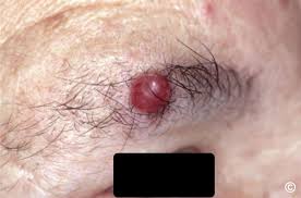 Image result for Merkel Cell Carcinoma