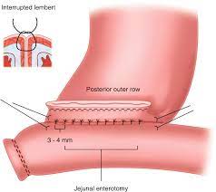 Fundamentals Of Gastrointestinal Anastomoses Springerlink